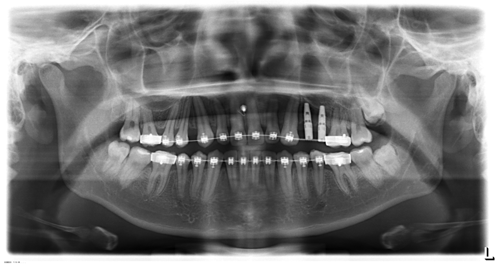 http://www.elitedental.com.vn/images/news/172/428/content/491/chinh_nha_phoi_hop_phuc_hinh_Implant.png
